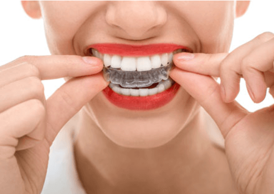 Teeth Whitening in Maple Ridge