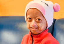 Baby:8acwhug5ccq= Progeria