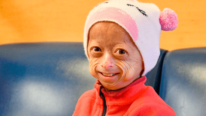 Baby:8acwhug5ccq= Progeria