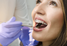 Dental Care Tips During Orthodontic Treatment in San Francisco